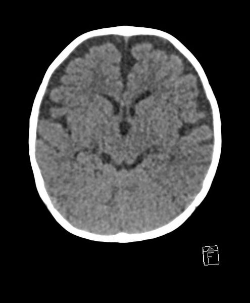 File:Benign enlargement of subarachnoid spaces in infancy (BESS) (Radiopaedia 87459-103795 Axial non-contrast 54).jpg