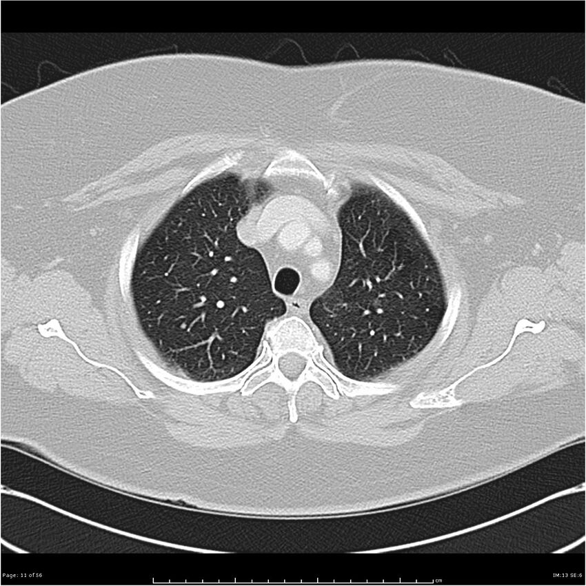 Benign metastasizing leiomyoma (Radiopaedia 26803-26962 Axial lung window 11).jpg