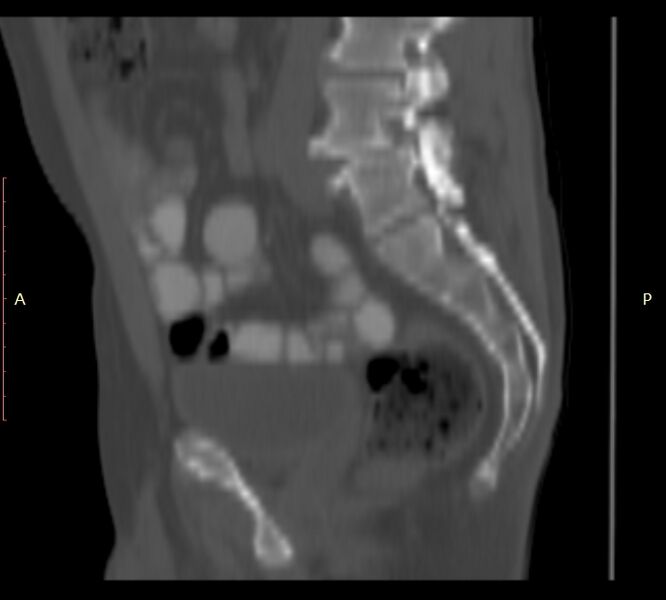 File:Bertolotti syndrome (Radiopaedia 58974-66235 Sagittal bone window 18).jpg