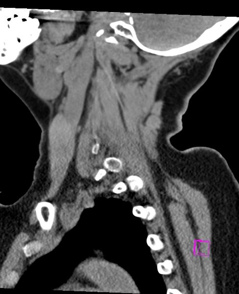 File:Bilateral atlanto-occipital assimilation (Radiopaedia 28350-28603 D 20).jpg
