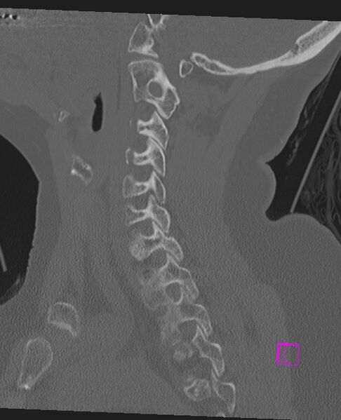 File:Bilateral atlanto-occipital assimilation (Radiopaedia 28350-28603 Sagittal bone window 31).jpg