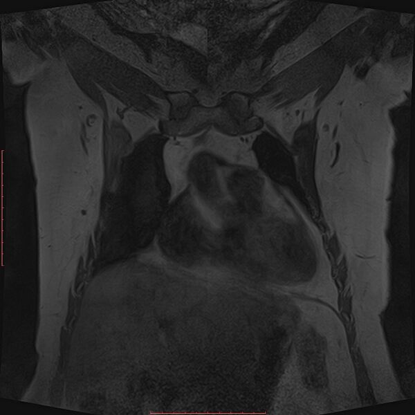 File:Bilateral breast implant rupture (Radiopaedia 24761-25027 G 9).jpg