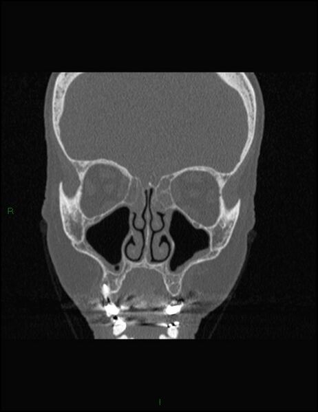 File:Bilateral frontal mucoceles (Radiopaedia 82352-96454 Coronal 137).jpg