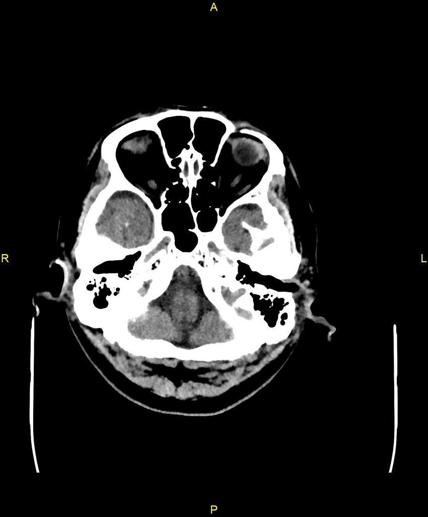 Bilateral isodense subdural hematomas (Radiopaedia 88621-105325 Axial non-contrast 16).jpg