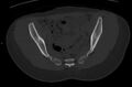 Bilateral mature cystic ovarian teratoma (Radiopaedia 88821-105592 Axial bone window 11).jpg