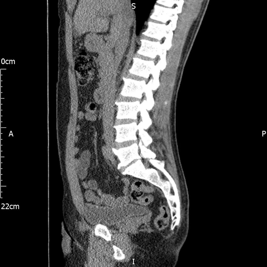 Bilateral medullary nephrocalcinosis with ureteric calculi (Radiopaedia 71269-81569 C 66).jpg