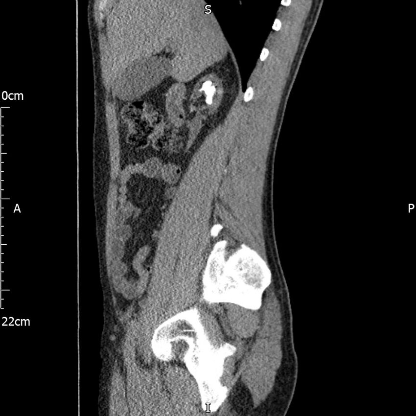 Bilateral medullary nephrocalcinosis with ureteric calculi (Radiopaedia 71269-81569 C 77).jpg