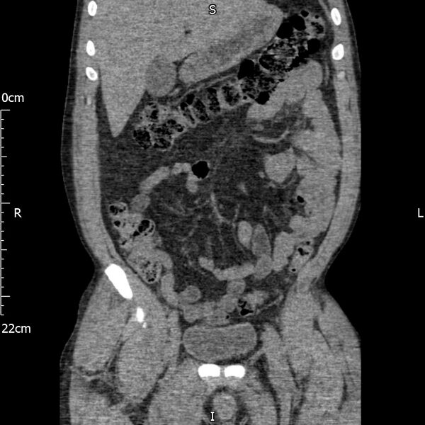 File:Bilateral medullary nephrocalcinosis with ureteric calculi (Radiopaedia 71269-81569 Coronal non-contrast 22).jpg
