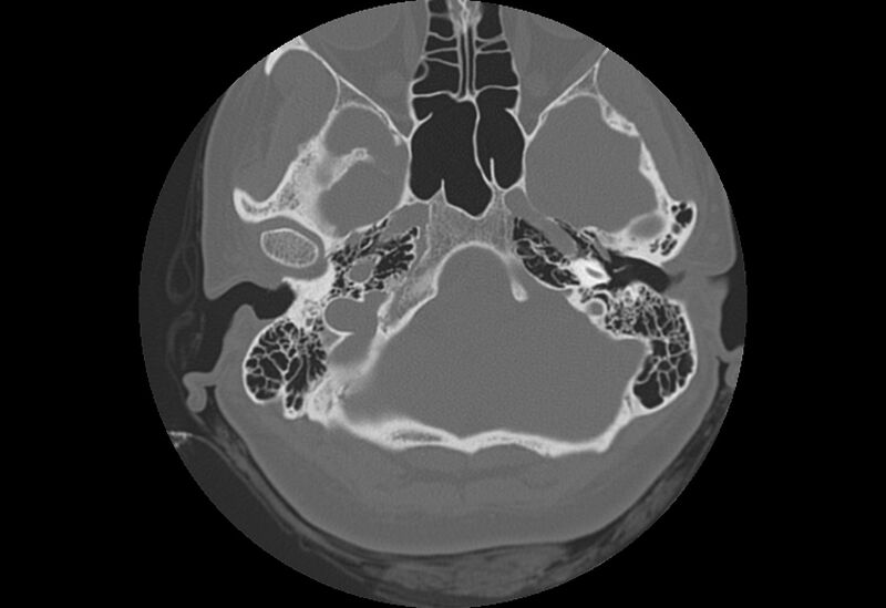 File:Bilateral otospongiosis (Radiopaedia 35447-36940 Axial bone window 18).jpg