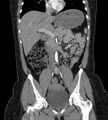 Bilateral ovarian mature cystic teratomas (Radiopaedia 79373-92457 B 29).jpg