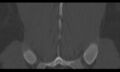 Bilateral pars defect (Radiopaedia 26691-26846 Coronal bone window 43).jpg