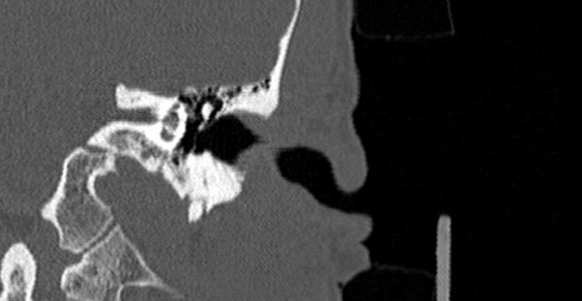 Bilateral temporal bone fractures (Radiopaedia 29482-29970 B 23).jpg