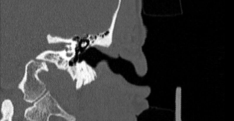 File:Bilateral temporal bone fractures (Radiopaedia 29482-29970 B 26).jpg