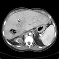 Biliary necrosis - liver transplant (Radiopaedia 21876-21846 B 19).jpg