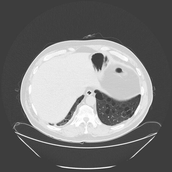 File:Birt-Hogg-Dubé syndrome (Radiopaedia 52578-58491 Axial lung window 54).jpg