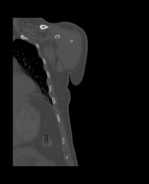 File:Bizarre parosteal osteochondromatous proliferation (Radiopaedia 84221-99501 Coronal bone window 5).jpg