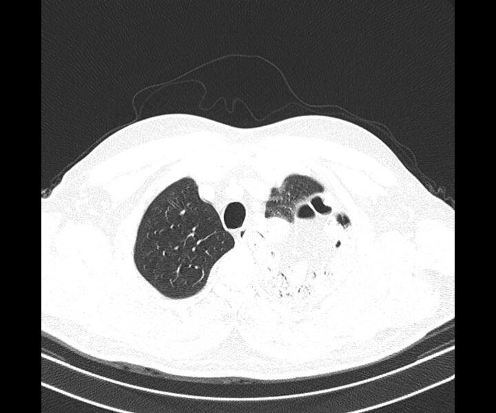 File:Bochdalek hernia - adult presentation (Radiopaedia 74897-85925 Axial lung window 7).jpg