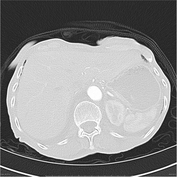 File:Boerhaave syndrome (Radiopaedia 26240-26362 Axial lung window 46).jpg
