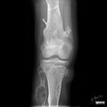 Bone lesion differential diagnosis - illustrations (Radiopaedia 79247-92261 B 1).jpg
