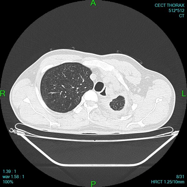 File:Bone metastases from lung carcinoma (Radiopaedia 54703-60937 Axial lung window 8).jpg