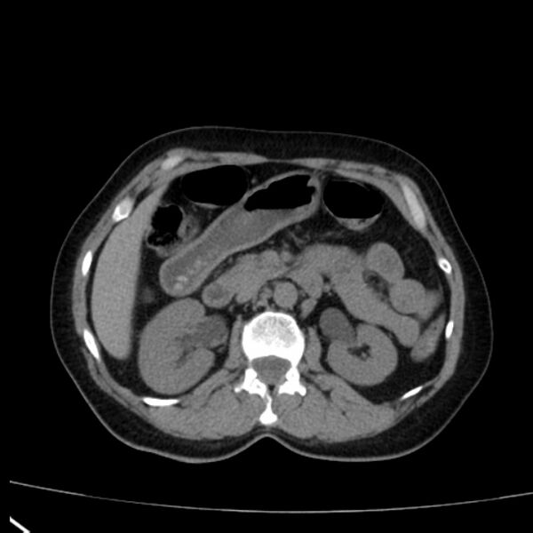 File:Bosniak renal cyst - type I (Radiopaedia 27479-27675 Axial non-contrast 34).jpg