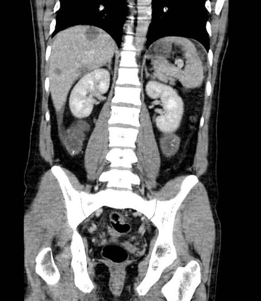 File:Bowel obstruction from colon carcinoma (Radiopaedia 22995-23028 C 50).jpg