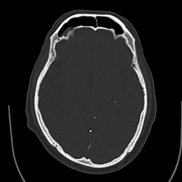 File:Brain Pantopaque remnants (Radiopaedia 78403-91048 Axial bone window 34).jpg