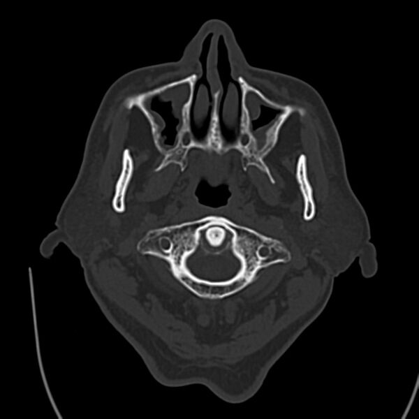File:Brain Pantopaque remnants (Radiopaedia 78403-91048 Axial bone window 8).jpg
