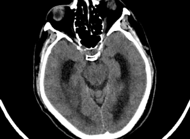 File:Brain abscess complicated by intraventricular rupture and ventriculitis (Radiopaedia 82434-96575 Axial non-contrast 14).jpg