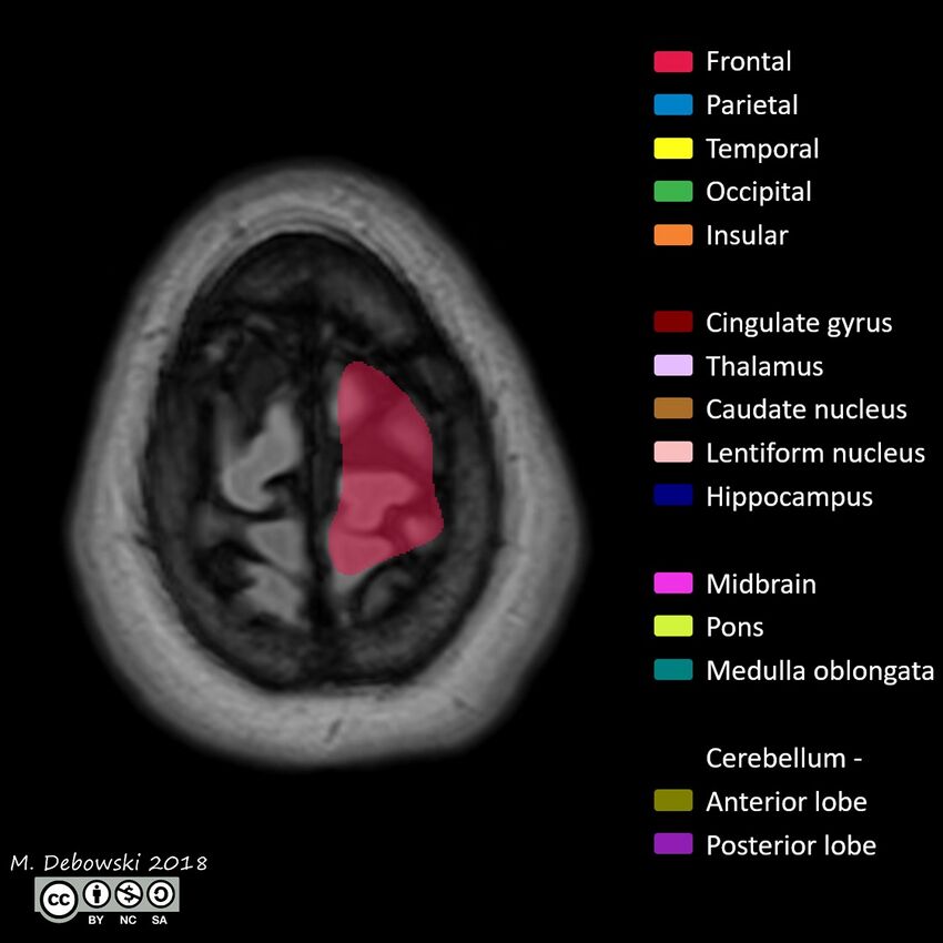 Brain lobes - annotated MRI (Radiopaedia 61691-69700 Axial 2).JPG