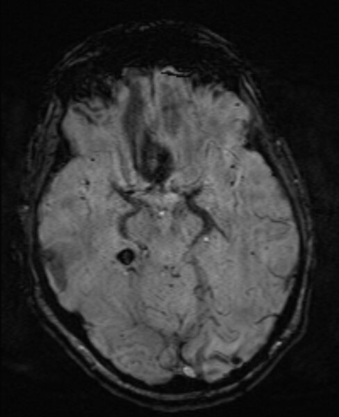 File:Brain metastases - lung cancer primary (Radiopaedia 75060-86115 Axial SWI 26).jpg