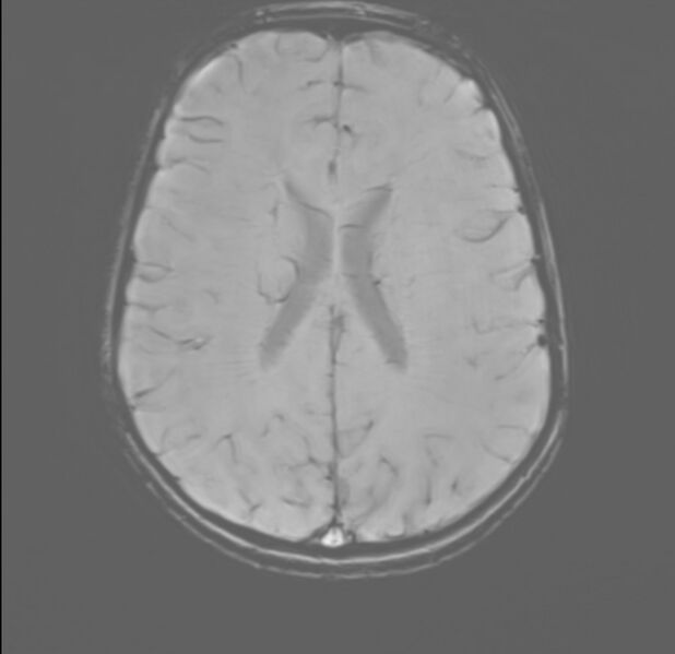 File:Brainstem glioma (Radiopaedia 70548-80674 Axial SWI 40).jpg