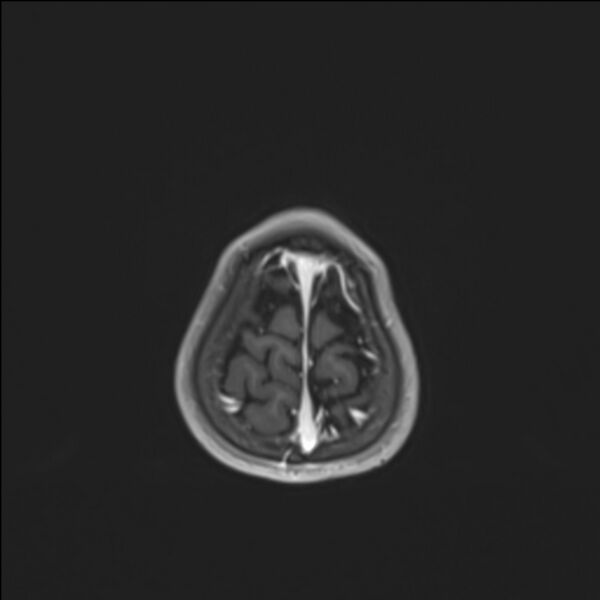 File:Brainstem glioma (Radiopaedia 70548-80674 Axial T1 C+ 143).jpg