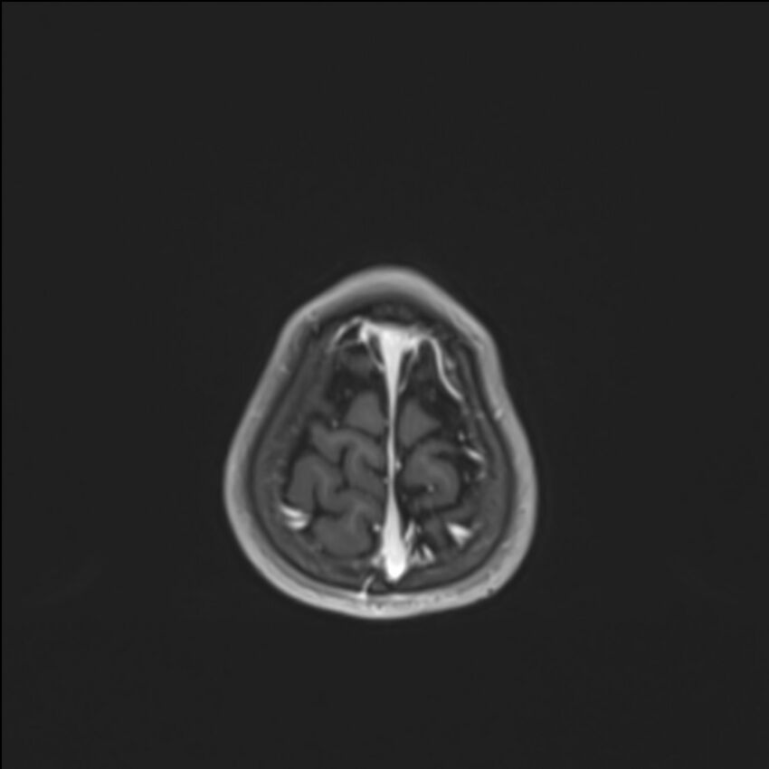 Brainstem glioma (Radiopaedia 70548-80674 Axial T1 C+ 143).jpg