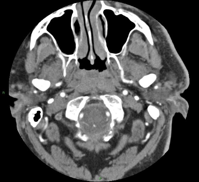 File:Brainstem hemorrhage (Radiopaedia 58794-66028 D 17).jpg