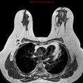 Breast carcinoma (multicentric multifocal in mammary Paget disease) (Radiopaedia 50966-56512 Axial T1 11).jpg