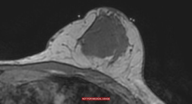 File:Breast lymphoma (MRI) (Radiopaedia 34999-36498 Axial T1 4).jpg
