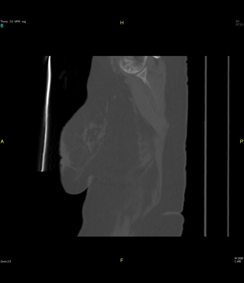 Breast primary with lung and bone metastases (Radiopaedia 40620-43228 Sagittal bone window 6).jpg