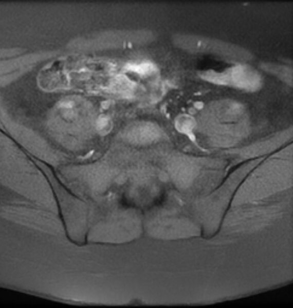 File:Broad ligament leiomyoma (Radiopaedia 81634-95516 Axial T1 fat sat 1).jpg