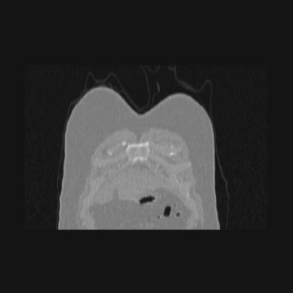 File:Bronchial atresia (Radiopaedia 60685-68439 Coronal lung window 77).jpg