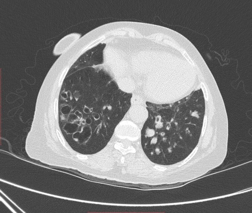 Bronchiectasis (Radiopaedia 72693-83293 Axial lung window 107).jpg