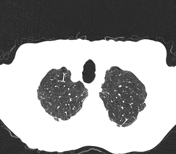 File:Bronchiolitis (Radiopaedia 24616-24887 Axial lung window 3).jpg