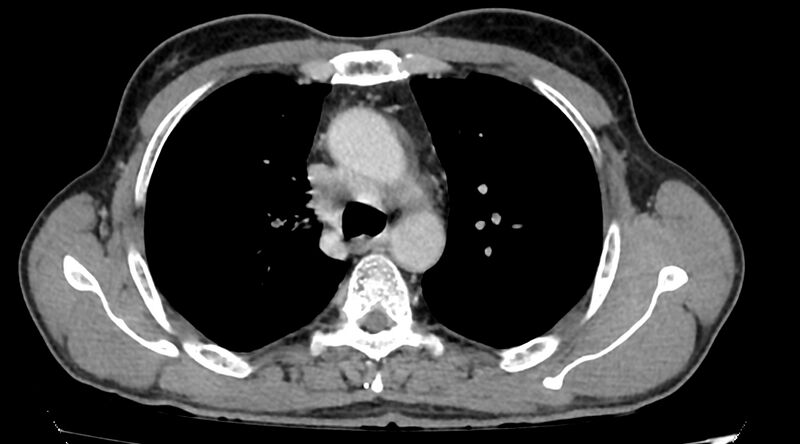 File:Bronchogenic carcinoma with superior vena cava syndrome (Radiopaedia 36497-38054 Axial C+ delayed 32).jpg