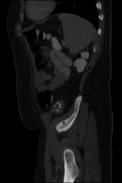 File:Brown tumors compressing the spinal cord (Radiopaedia 68442-77988 H 45).jpg