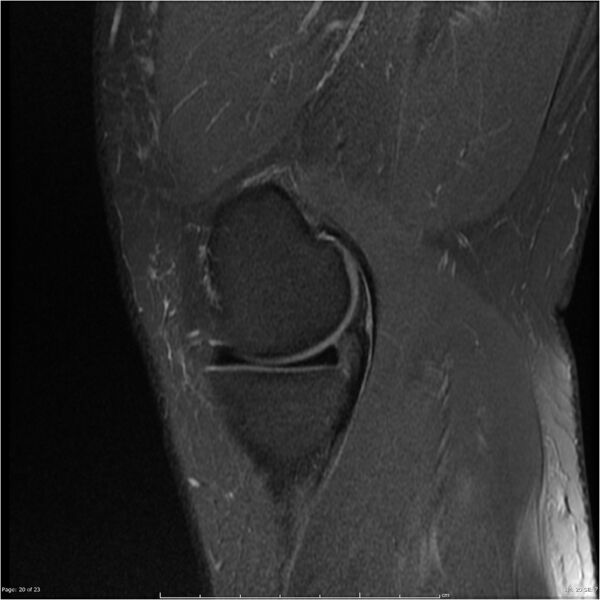 File:Bucket handle tear - lateral meniscus (Radiopaedia 7246-8187 Sagittal T2 fat sat 20).jpg