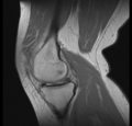 Bucket handle tear - medial meniscus (Radiopaedia 24900-25163 Sagittal T2 5).png