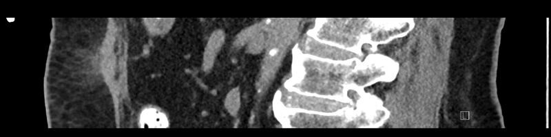 File:Buried bumper syndrome - gastrostomy tube (Radiopaedia 63843-72575 Sagittal Inject 58).jpg