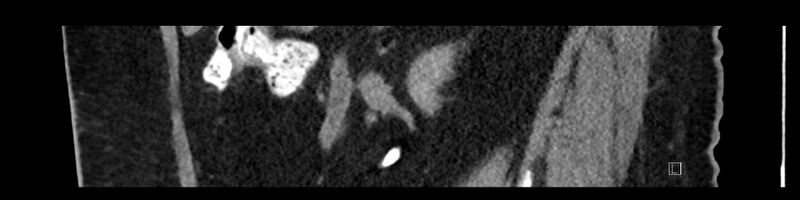 File:Buried bumper syndrome - gastrostomy tube (Radiopaedia 63843-72575 Sagittal Inject 80).jpg
