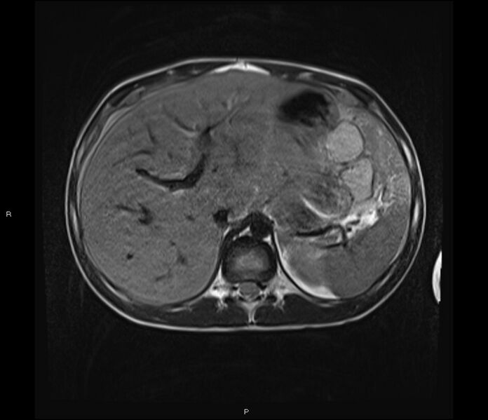 File:Burkitt lymphoma (bowel) (Radiopaedia 68839-78557 Axial T2 14).jpg