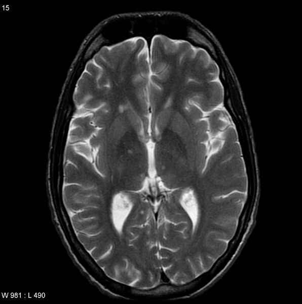 File:CMV ventriculitis and encephalitis (Radiopaedia 5416-7166 T2 3).jpg